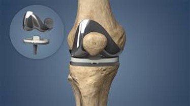 Joint Replacement         