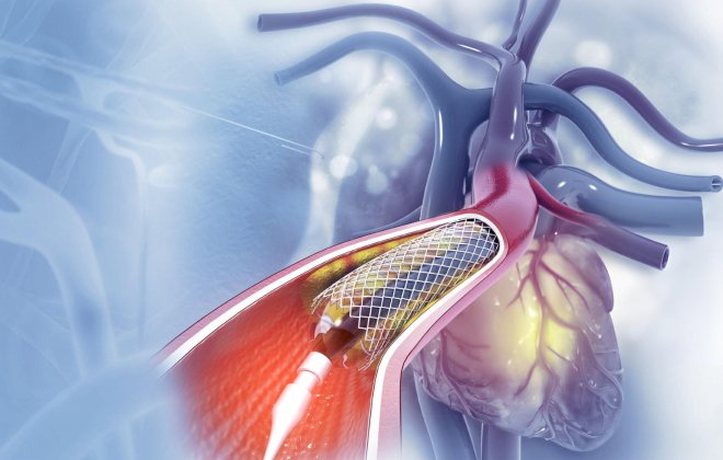 Interventional Cardiology 