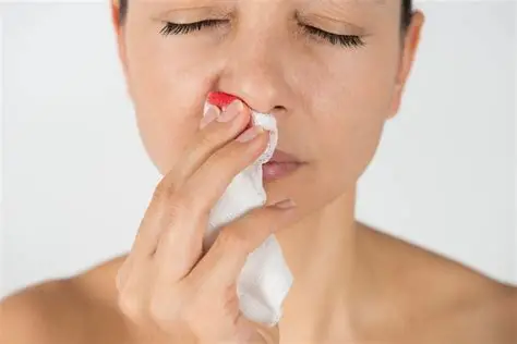 Epistaxis (Nosebleed)